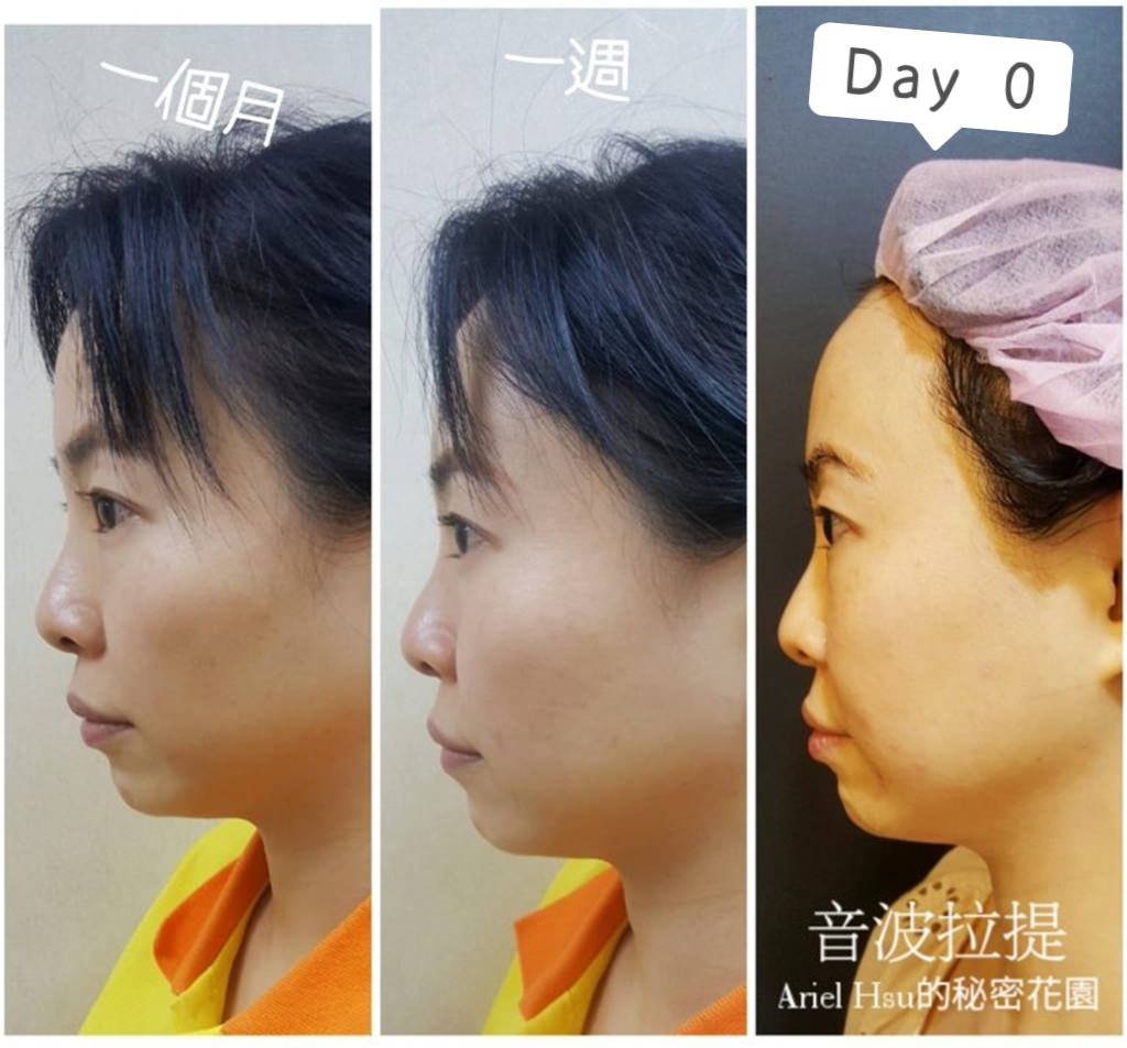 【醫美3】我的音波拉提療程全紀錄90天比較圖：韓國音波拉提要打幾條？音波韓國機&術前術後注意