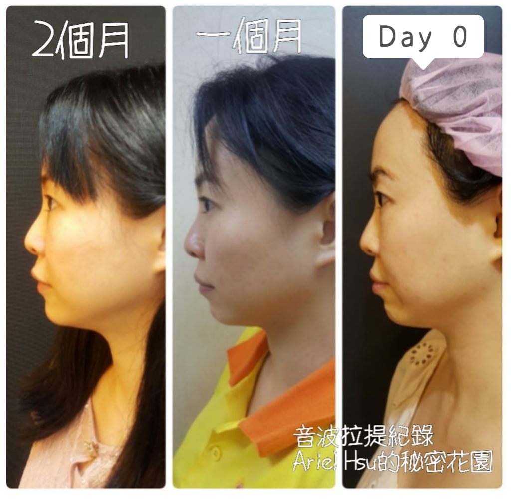 【醫美3】我的音波拉提療程全紀錄90天比較圖：韓國音波拉提要打幾條？音波韓國機&術前術後注意